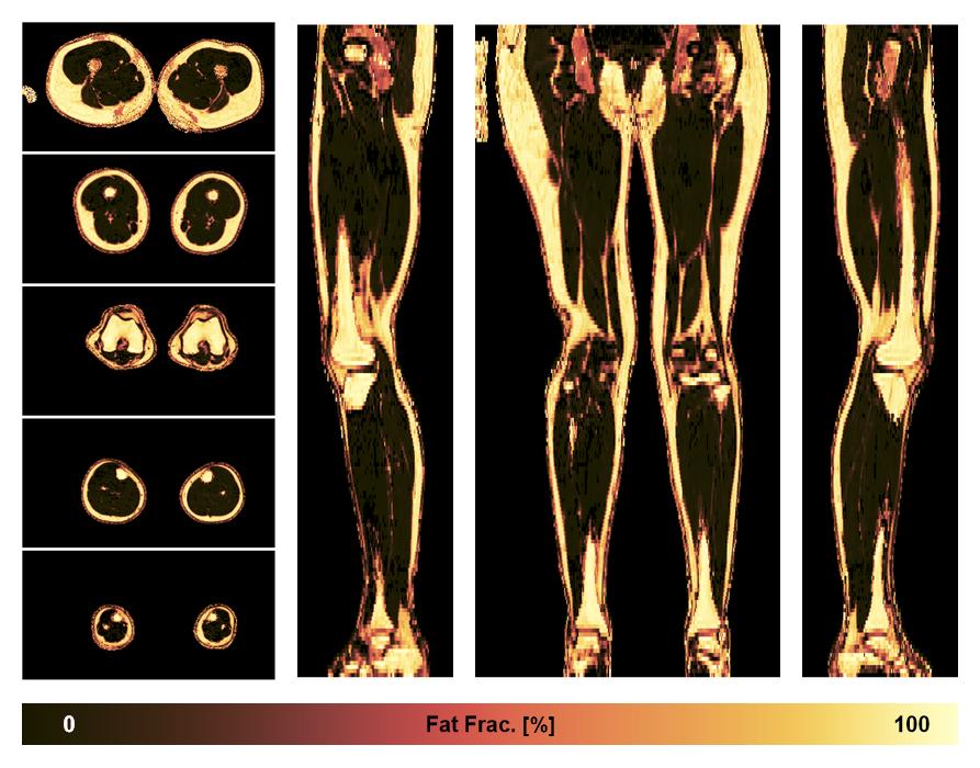 The fat fraction of the lower extremity obtained from the dixon reconstruction for muscle water fat quantification.